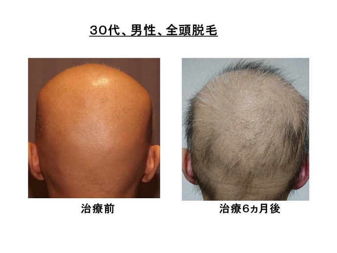 円形脱毛症　病院""